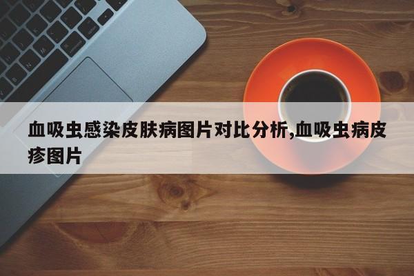 血吸虫感染皮肤病图片对比分析,血吸虫病皮疹图片